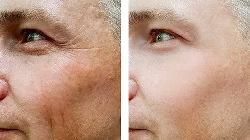 A before and after photo where the creases around the edge of the cheekbone and eyes are treated.